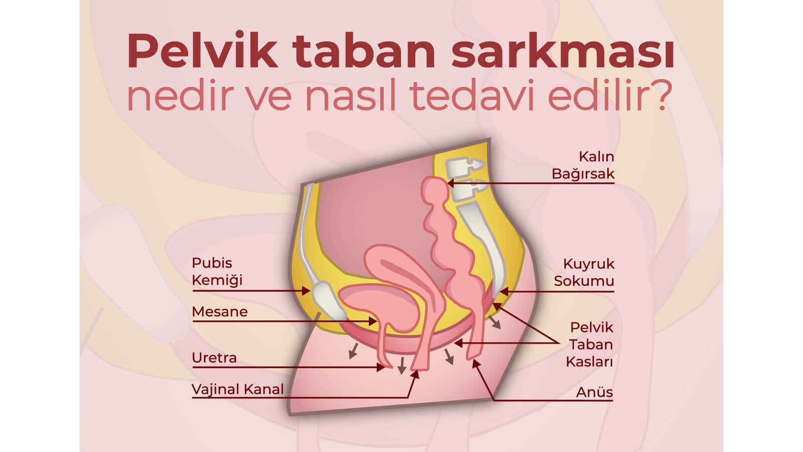 Pelvik Taban Sarkması Nedir ve Nasıl Tedavi Edilir?